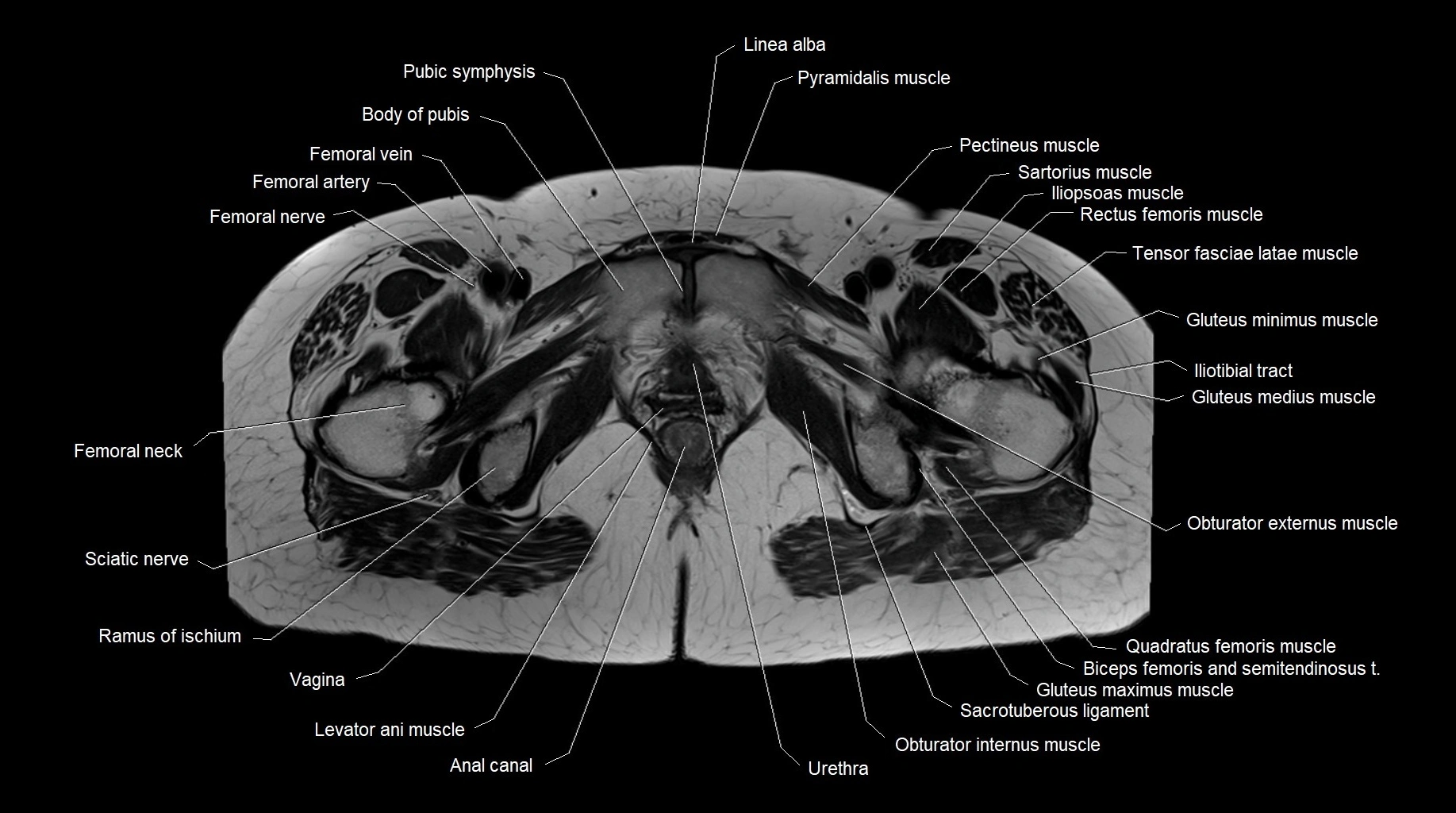 MRI 3T pelvis axial cross section anatomy image 27.webp